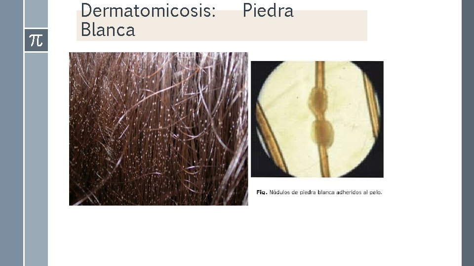 Dermatomicosis: Blanca Piedra 