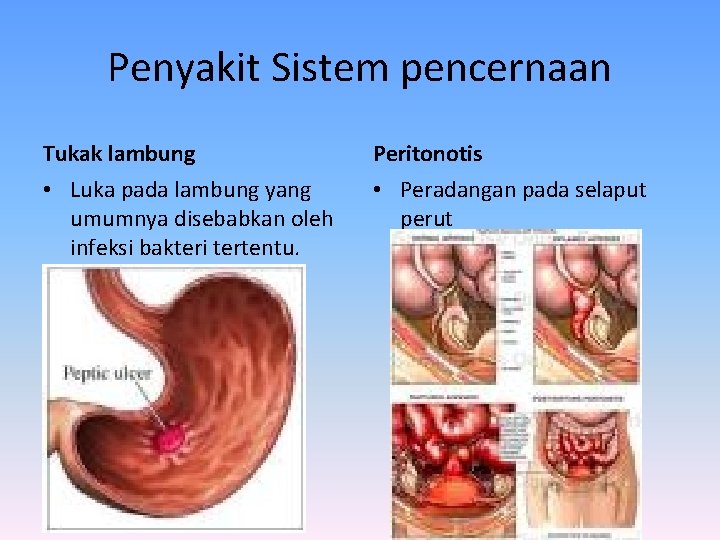 Penyakit Sistem pencernaan Tukak lambung Peritonotis • Luka pada lambung yang umumnya disebabkan oleh