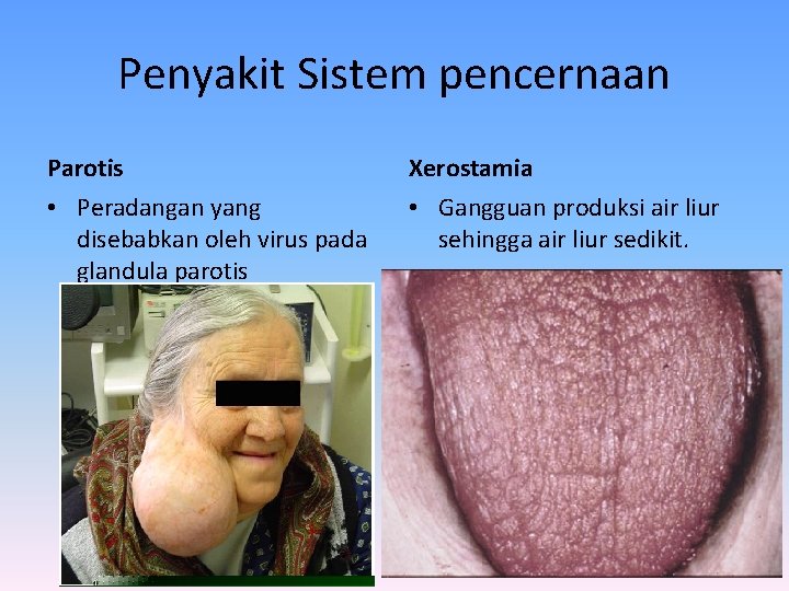 Penyakit Sistem pencernaan Parotis Xerostamia • Peradangan yang disebabkan oleh virus pada glandula parotis