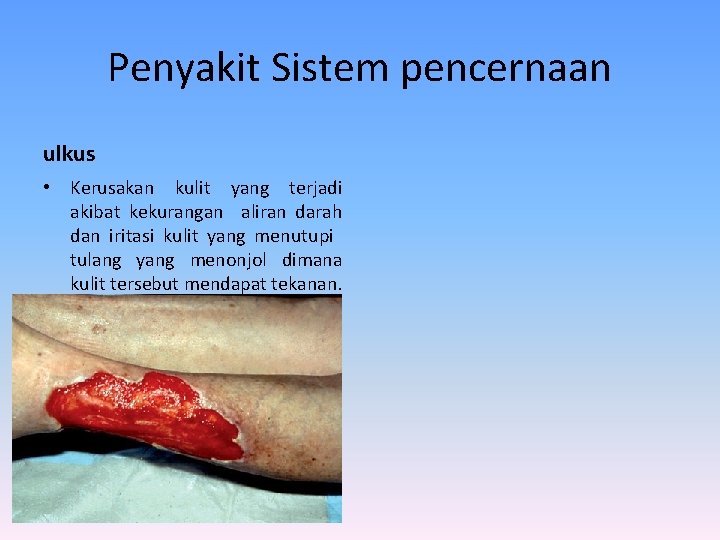 Penyakit Sistem pencernaan ulkus • Kerusakan kulit yang terjadi akibat kekurangan aliran darah dan