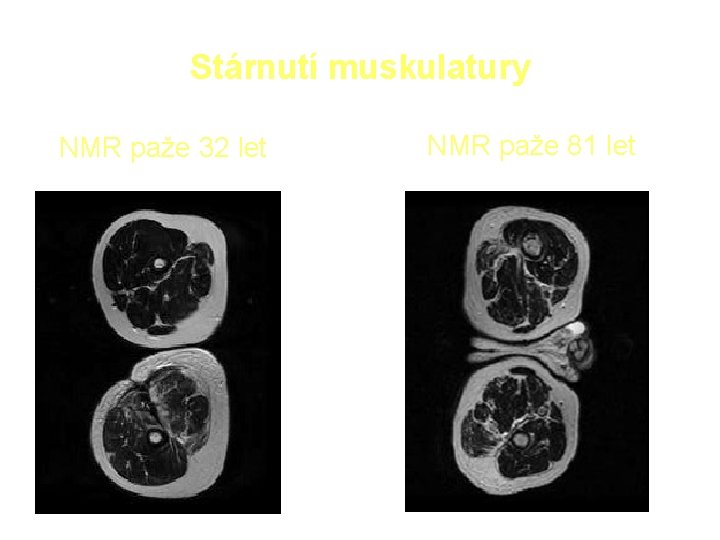 Stárnutí muskulatury NMR paže 32 let NMR paže 81 let 