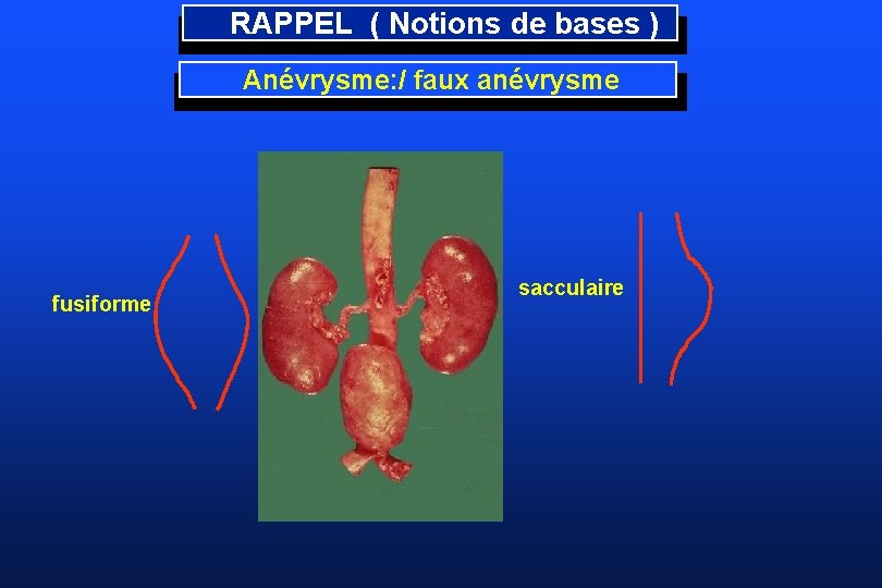 RAPPEL ( Notions de bases ) Anévrysme: / faux anévrysme fusiforme sacculaire 