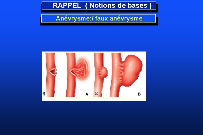 RAPPEL ( Notions de bases ) Anévrysme: / faux anévrysme 