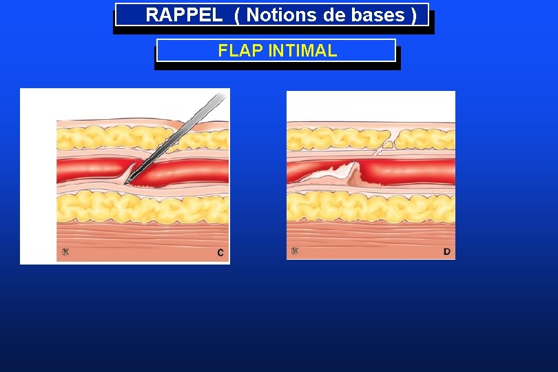 RAPPEL ( Notions de bases ) FLAP INTIMAL 