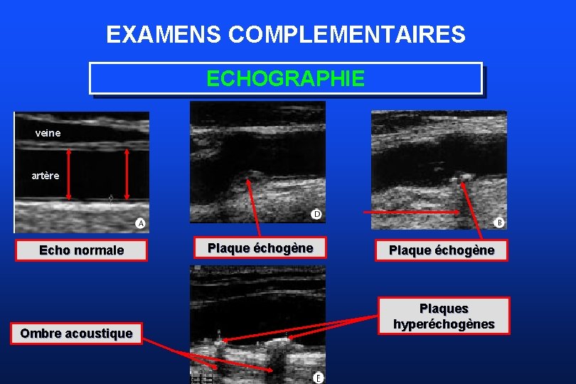 EXAMENS COMPLEMENTAIRES ECHOGRAPHIE veine artère Echo normale Ombre acoustique Plaque échogène Plaques hyperéchogènes 