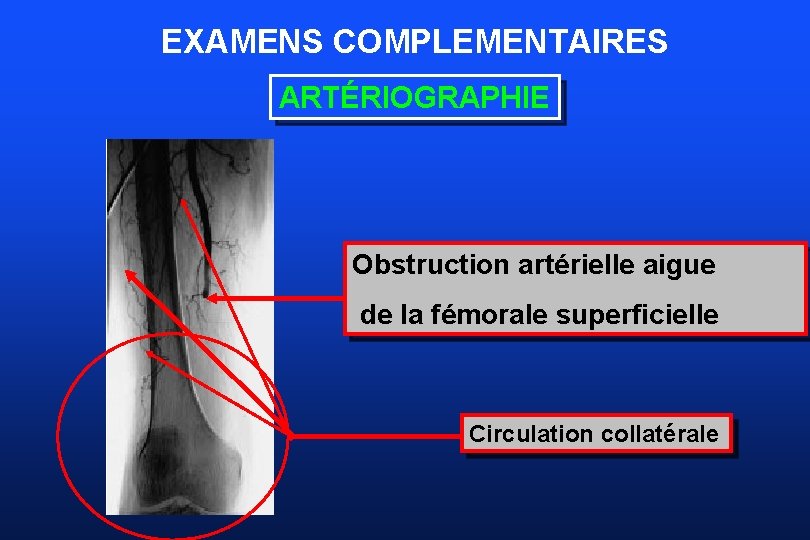 EXAMENS COMPLEMENTAIRES ARTÉRIOGRAPHIE Obstruction artérielle aigue de la fémorale superficielle Circulation collatérale 