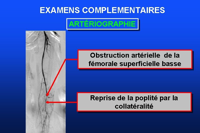EXAMENS COMPLEMENTAIRES ARTÉRIOGRAPHIE Obstruction artérielle de la fémorale superficielle basse Reprise de la poplité