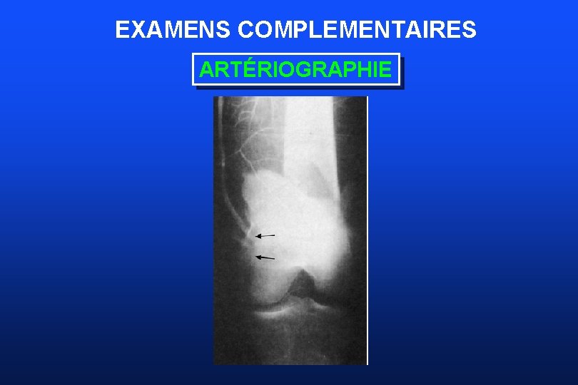 EXAMENS COMPLEMENTAIRES ARTÉRIOGRAPHIE 