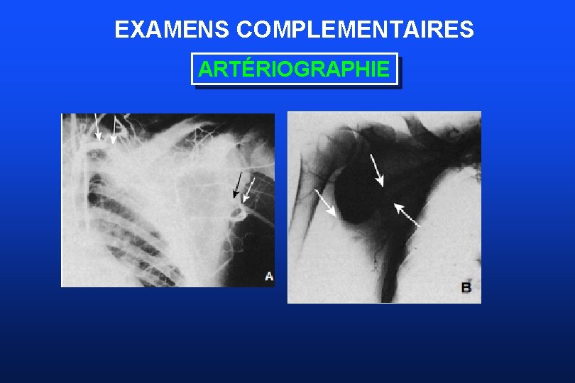 EXAMENS COMPLEMENTAIRES ARTÉRIOGRAPHIE 