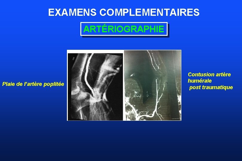 EXAMENS COMPLEMENTAIRES ARTÉRIOGRAPHIE Plaie de l’artère poplitée Contusion artère humérale post traumatique 
