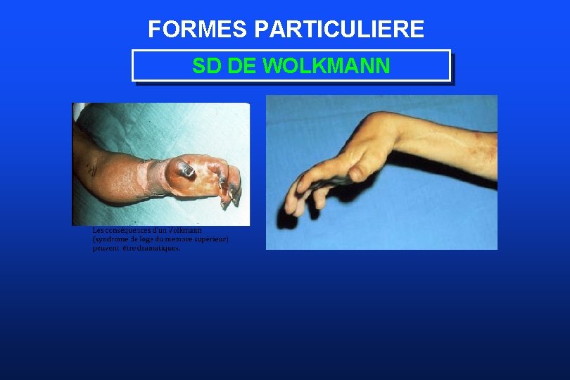 FORMES PARTICULIERE SD DE WOLKMANN 