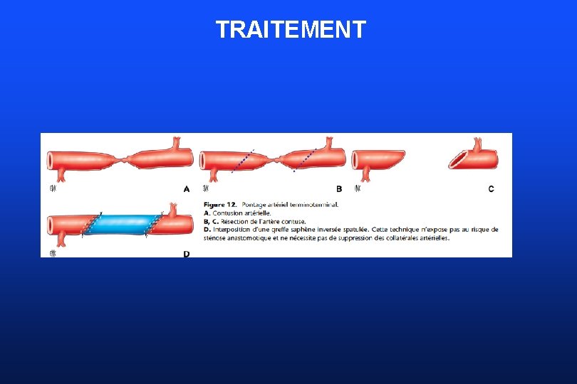 TRAITEMENT 