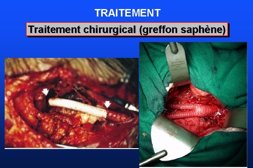 TRAITEMENT Traitement chirurgical (greffon saphène) 