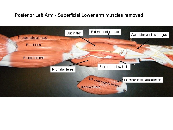 Posterior Left Arm - Superficial Lower arm muscles removed Supinator Extensor digitorum Abductor pollicis
