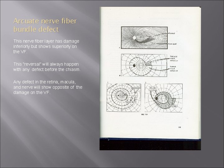 Arcuate nerve fiber bundle defect This nerve fiber layer has damage inferiorly but shows