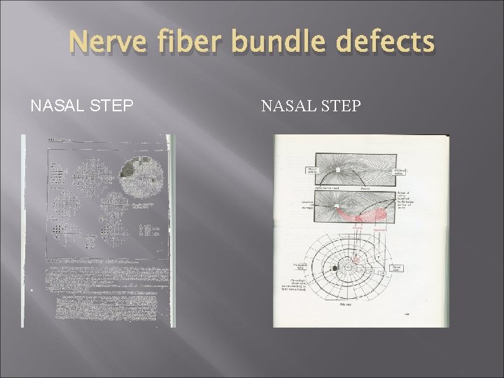Nerve fiber bundle defects NASAL STEP 