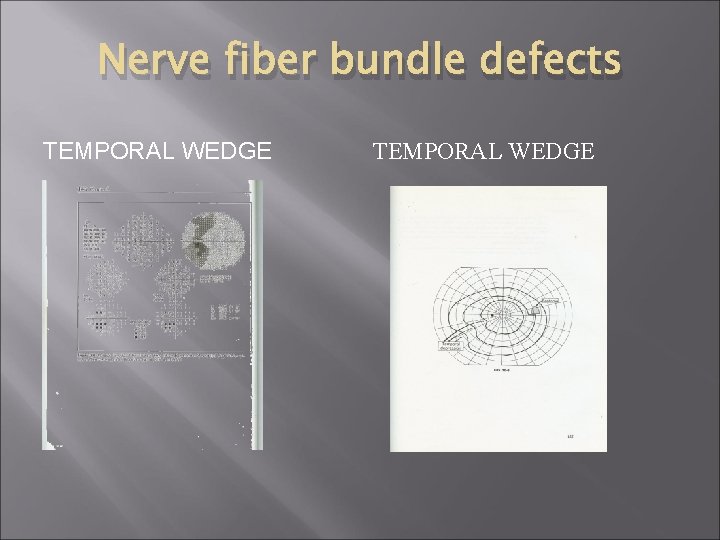Nerve fiber bundle defects TEMPORAL WEDGE 