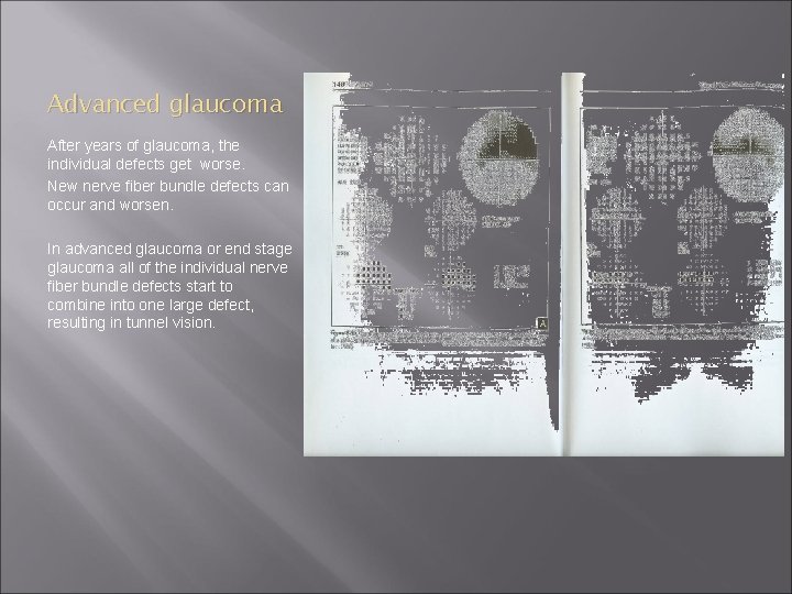 Advanced glaucoma After years of glaucoma, the individual defects get worse. New nerve fiber