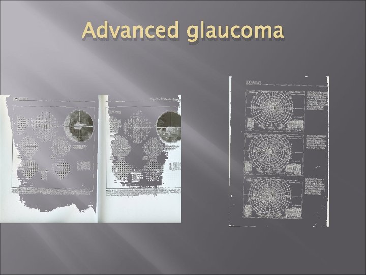Advanced glaucoma 