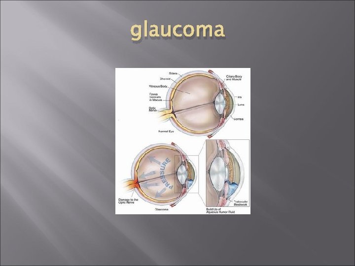glaucoma 