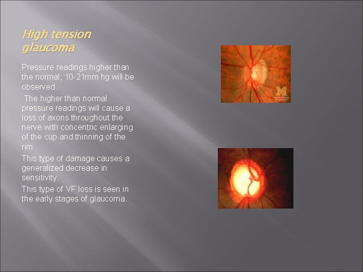 High tension glaucoma Pressure readings higher than the normal, 10 -21 mm hg will