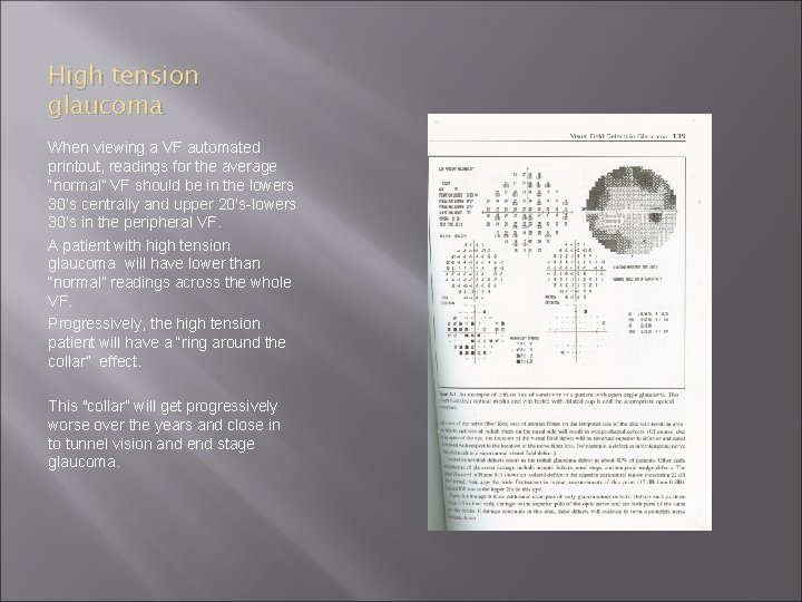 High tension glaucoma When viewing a VF automated printout, readings for the average “normal”