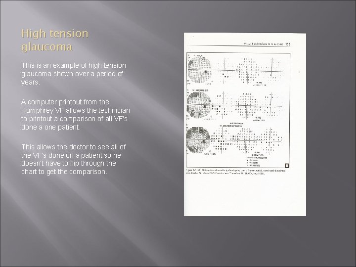 High tension glaucoma This is an example of high tension glaucoma shown over a