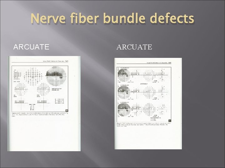 Nerve fiber bundle defects ARCUATE 