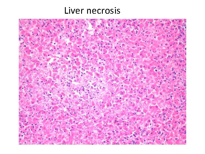 Liver necrosis 