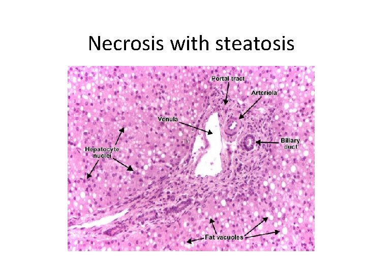 Necrosis with steatosis 