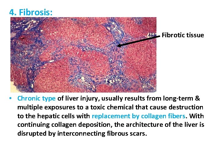 4. Fibrosis: Fibrotic tissue • Chronic type of liver injury, usually results from long-term