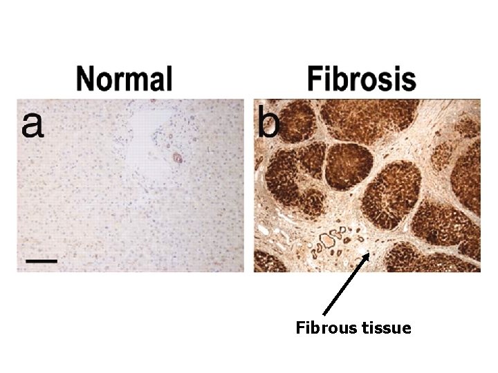 Fibrous tissue 