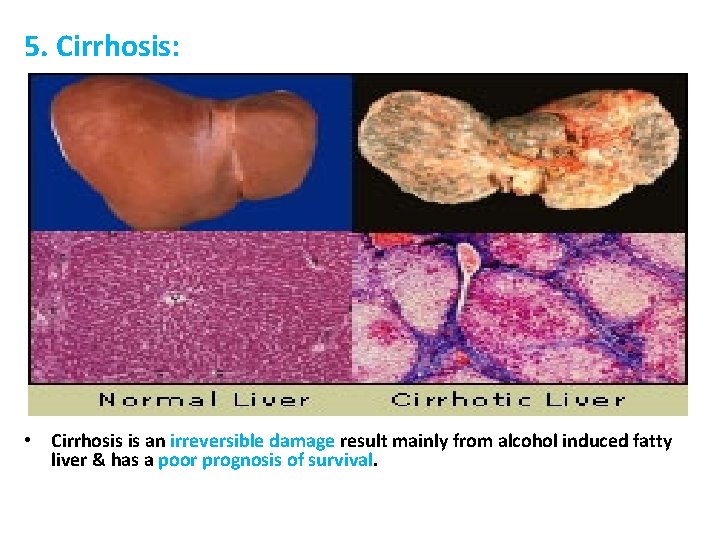 5. Cirrhosis: • Cirrhosis is an irreversible damage result mainly from alcohol induced fatty