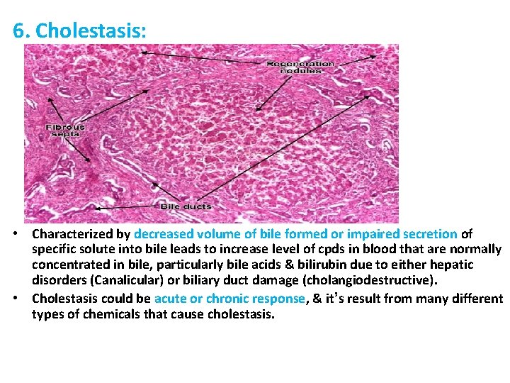 6. Cholestasis: • Characterized by decreased volume of bile formed or impaired secretion of