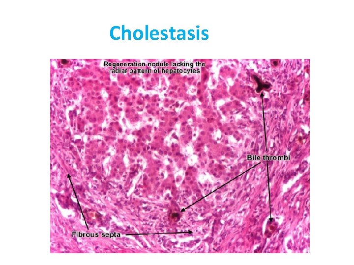 Cholestasis 