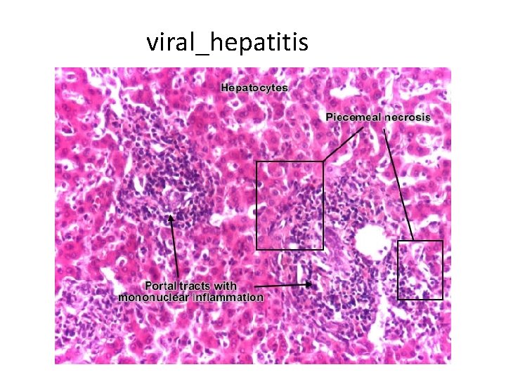 viral_hepatitis 