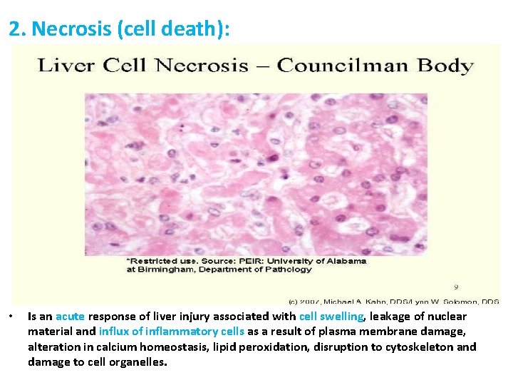 2. Necrosis (cell death): • Is an acute response of liver injury associated with