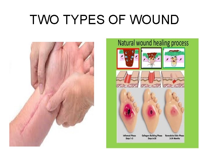 TWO TYPES OF WOUND 