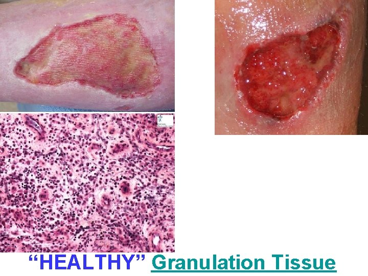 “HEALTHY” Granulation Tissue 