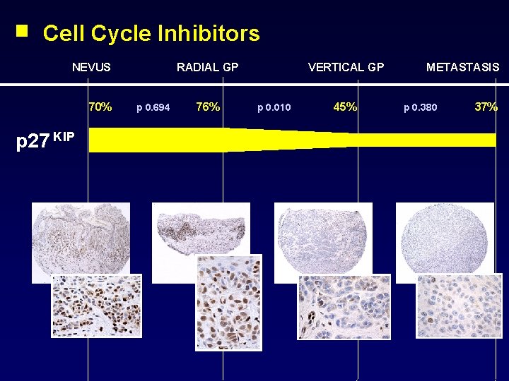 Cell Cycle Inhibitors NEVUS 70% p 27 KIP RADIAL GP p 0. 694 76%
