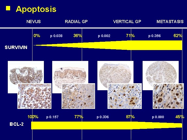 Apoptosis NEVUS 0% RADIAL GP p 0. 038 36% VERTICAL GP p 0. 002