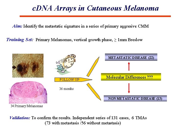 c. DNA Arrays in Cutaneous Melanoma Aim: Identify the metastatic signature in a series