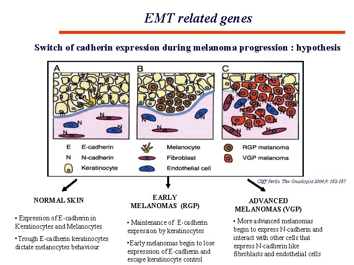 EMT related genes Switch of cadherin expression during melanoma progression : hypothesis Cliff Perlis.