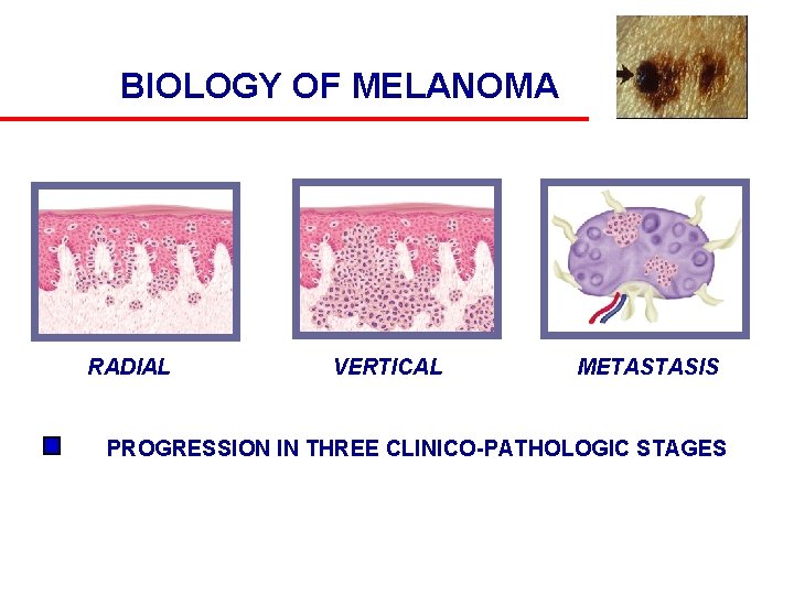 BIOLOGY OF MELANOMA RADIAL VERTICAL METASTASIS PROGRESSION IN THREE CLINICO-PATHOLOGIC STAGES 