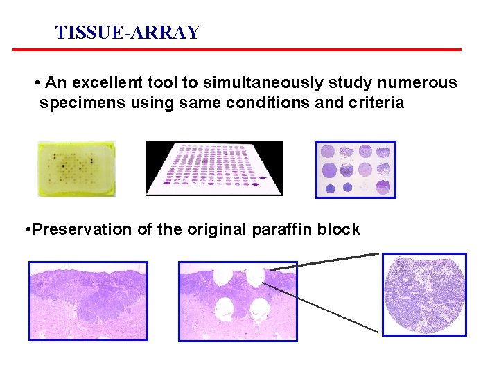 TISSUE-ARRAY • An excellent tool to simultaneously study numerous specimens using same conditions and