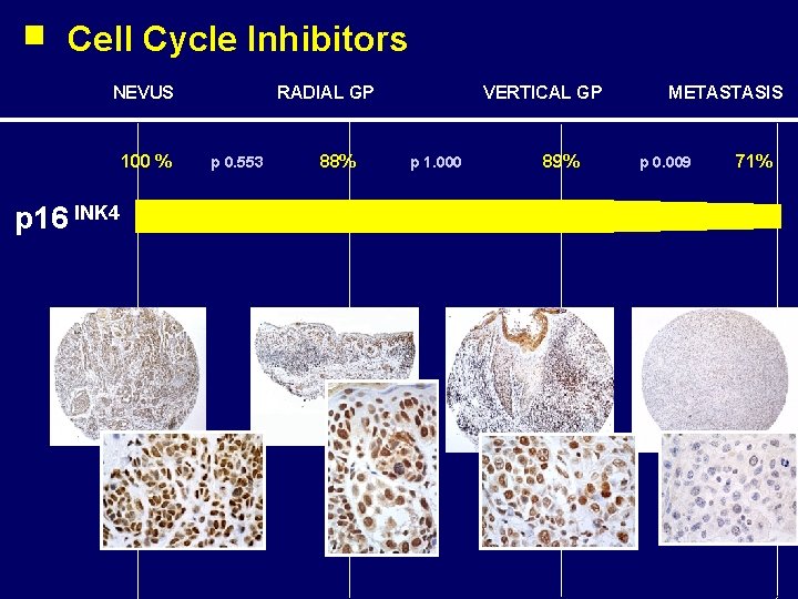 Cell Cycle Inhibitors NEVUS 100 % p 16 INK 4 RADIAL GP p 0.