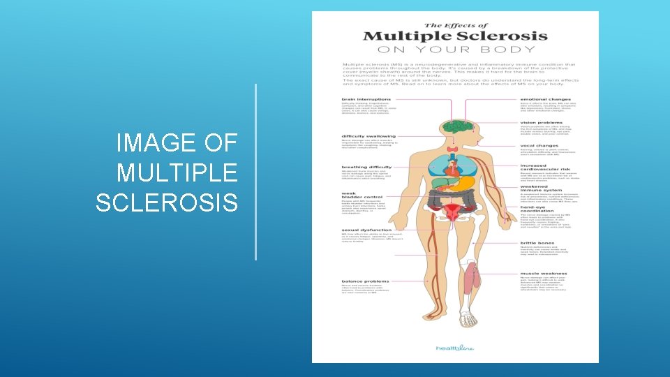 IMAGE OF MULTIPLE SCLEROSIS IMAGE OF MULTIPLE SCLEROSIS