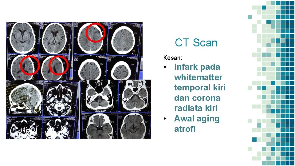 CT Scan Kesan: • Infark pada whitematter temporal kiri dan corona radiata kiri • CT Scan Kesan: • Infark pada whitematter temporal kiri dan corona radiata kiri •