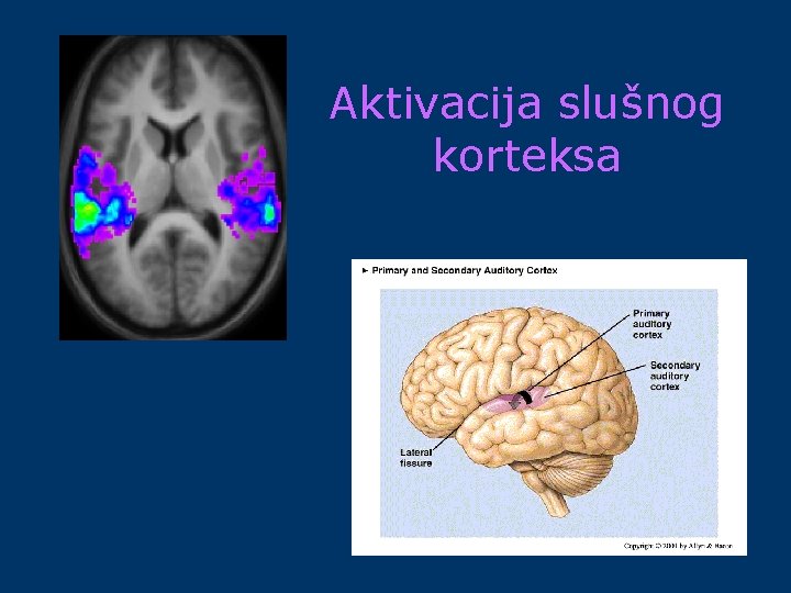 Aktivacija slušnog korteksa 