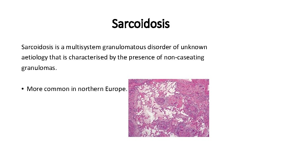 Sarcoidosis is a multisystem granulomatous disorder of unknown aetiology that is characterised by the